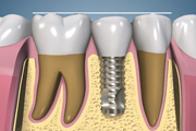 Implant Crown and Occlusion-Correct
